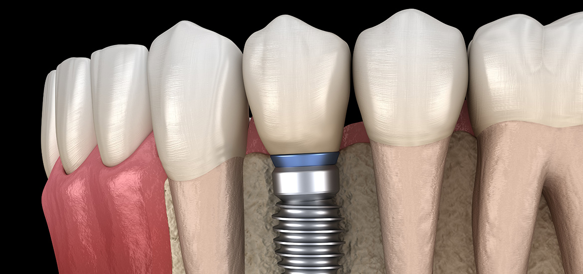 Zahnimplantate in Veitsbronn – endlich wieder feste Zähne!