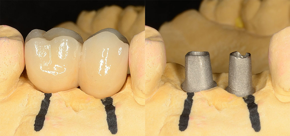 Fester Zahnersatz in Veitsbronn (Zahn­implantate)